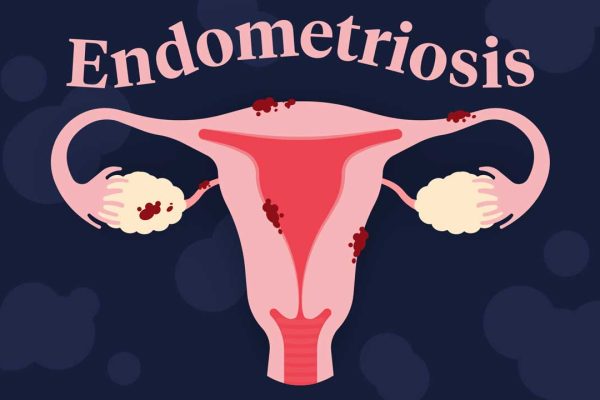 10 Hal yang Harus Diketahui tentang Endometriosis