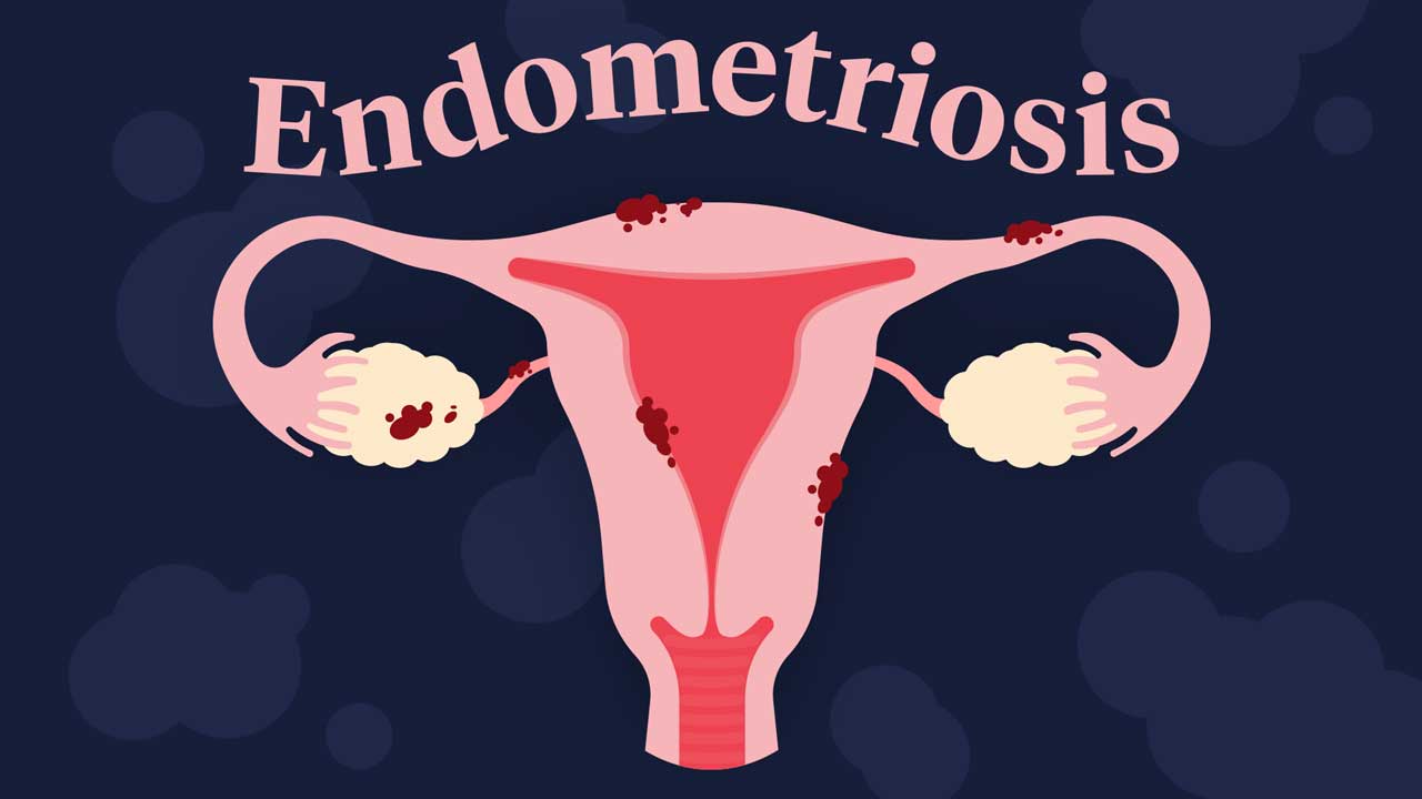 10 Hal yang Harus Diketahui tentang Endometriosis