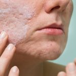 5 Cara Merawat Kulit Sensitif yang Rentan Berjerawat