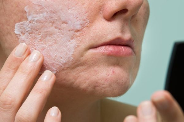 5 Cara Merawat Kulit Sensitif yang Rentan Berjerawat