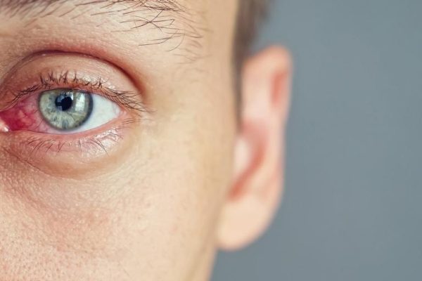 5 Tips Efektif Menghindari Infeksi Mata
