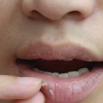 7 Cara Mengatasi Bibir Gatal dan Mengelupas