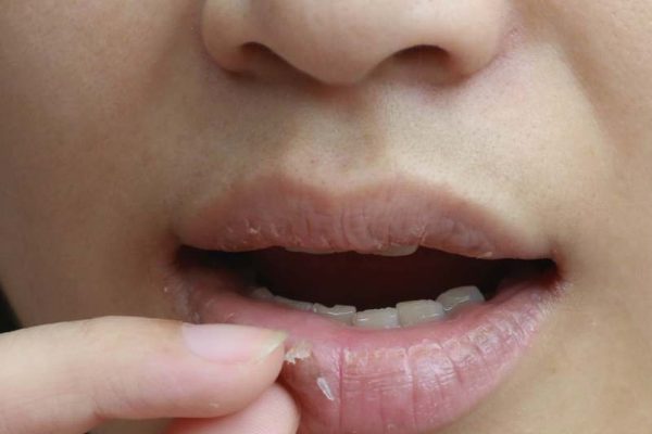 7 Cara Mengatasi Bibir Gatal dan Mengelupas 7 Cara Mengatasi Bibir Gatal dan Mengelupas