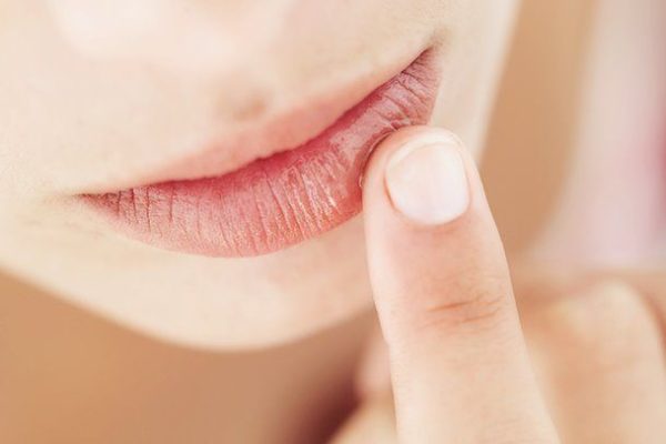 7 Penyebab Bibir Kering yang Sering Diabaikan 7 Penyebab Bibir Kering yang Sering Diabaikan