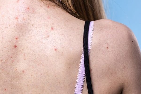 10 Cara Mengatasi Jerawat Punggung yang Bikin Gak Nyaman 10 Cara Mengatasi Jerawat Punggung yang Bikin Gak Nyaman