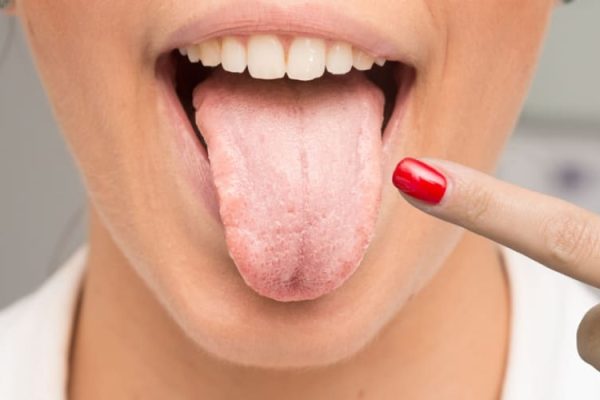 5 Tips Mendeteksi Masalah Kesehatan Lewat Warna Lidah 5 Tips Mendeteksi Masalah Kesehatan Lewat Warna Lidah