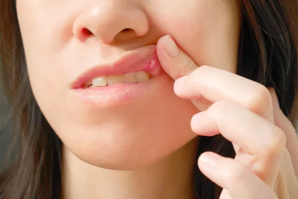 10 Tips Mengatasi Sariawan agar Tidak Mengganggu Makan