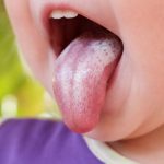10 Cara Mencegah Infeksi Jamur pada Lidah