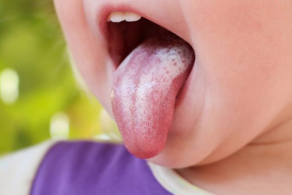 10 Cara Mencegah Infeksi Jamur pada Lidah