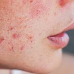 7 Cara Membedakan Jerawat Hormonal dan Jerawat Biasa di Dagu