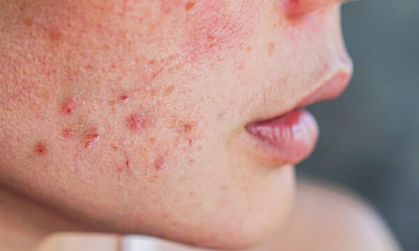 7 Cara Membedakan Jerawat Hormonal dan Jerawat Biasa di Dagu 7 Cara Membedakan Jerawat Hormonal dan Jerawat Biasa di Dagu
