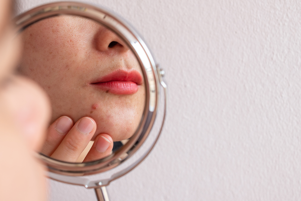 7 Tips Menghindari Jerawat Saat Menstruasi